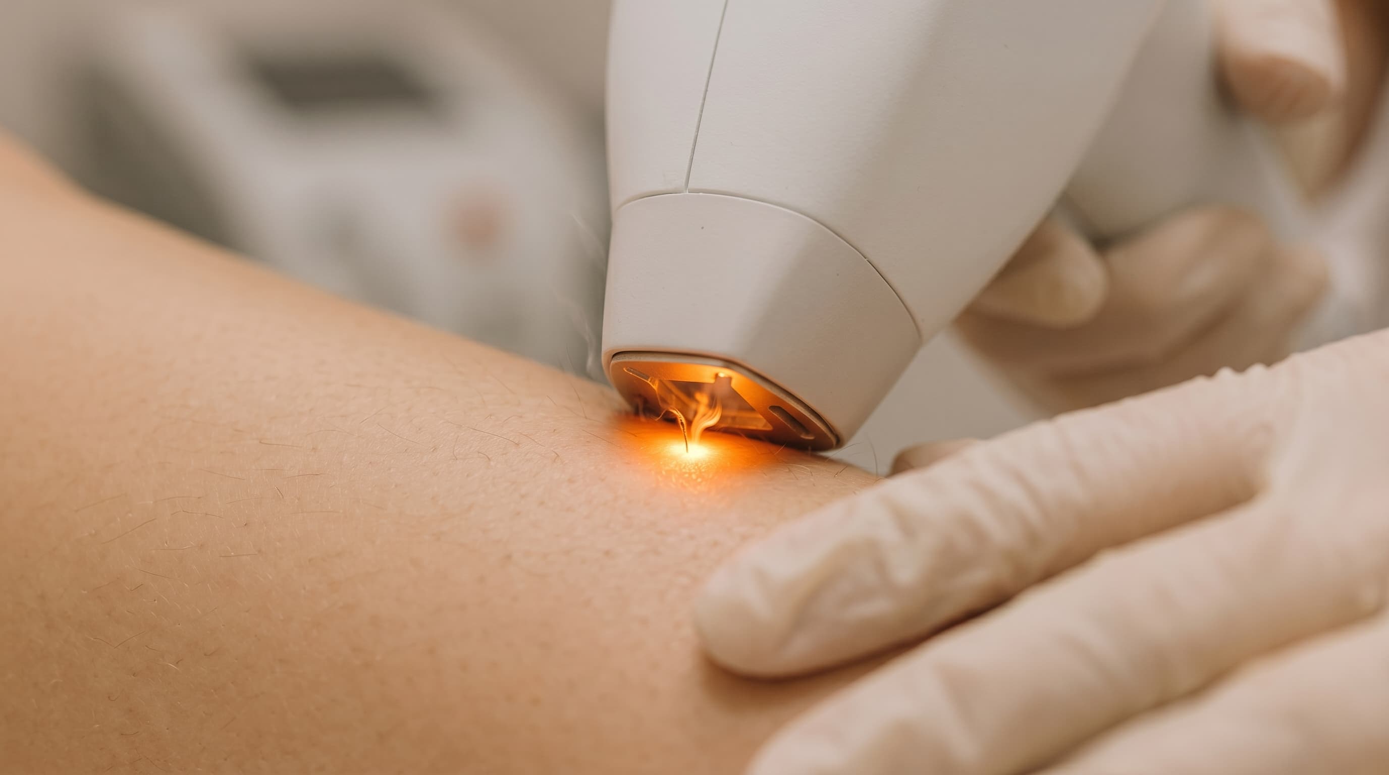 IPL Hair Removal