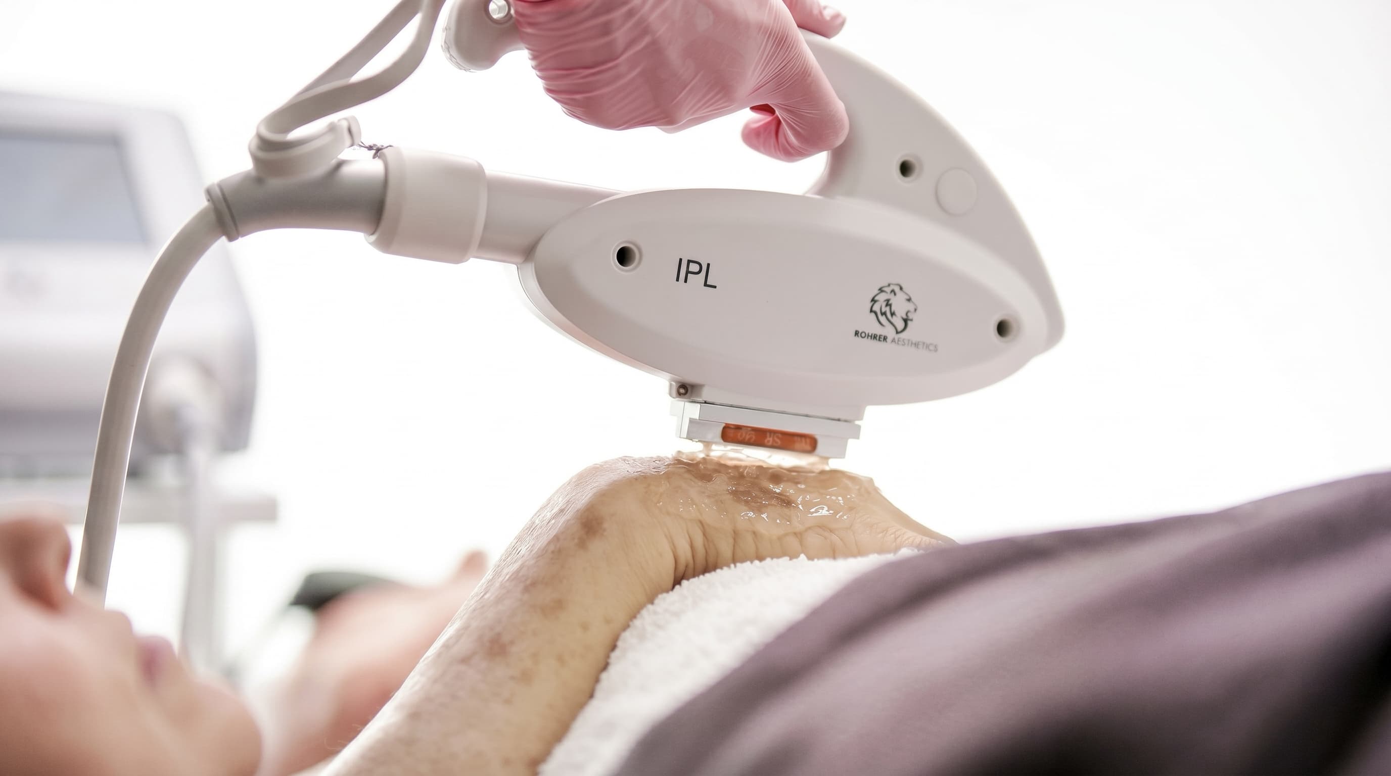 IPL Pigmentation Treatment
