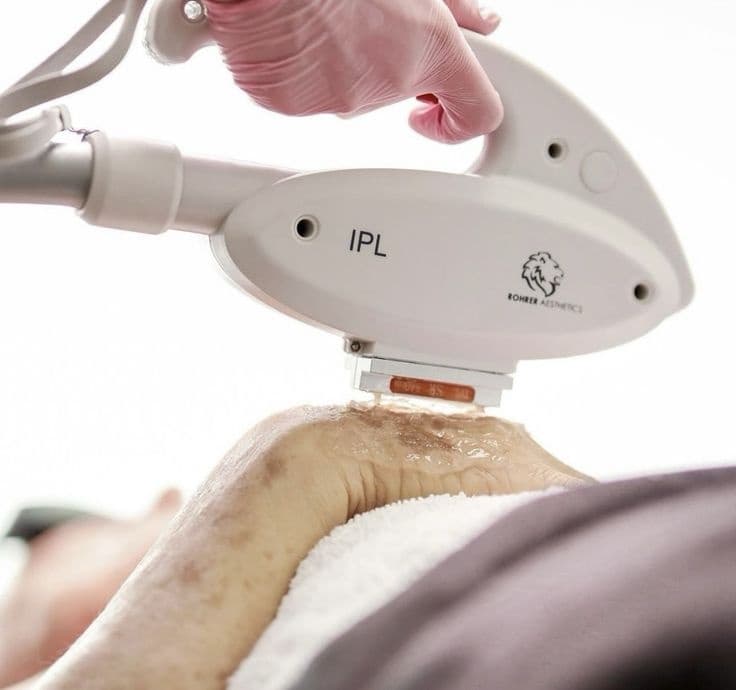 IPL Pigmentation Treatment