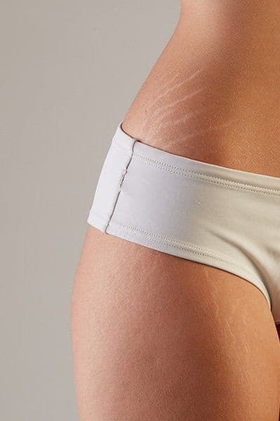 Stretch Mark Renewal Laser