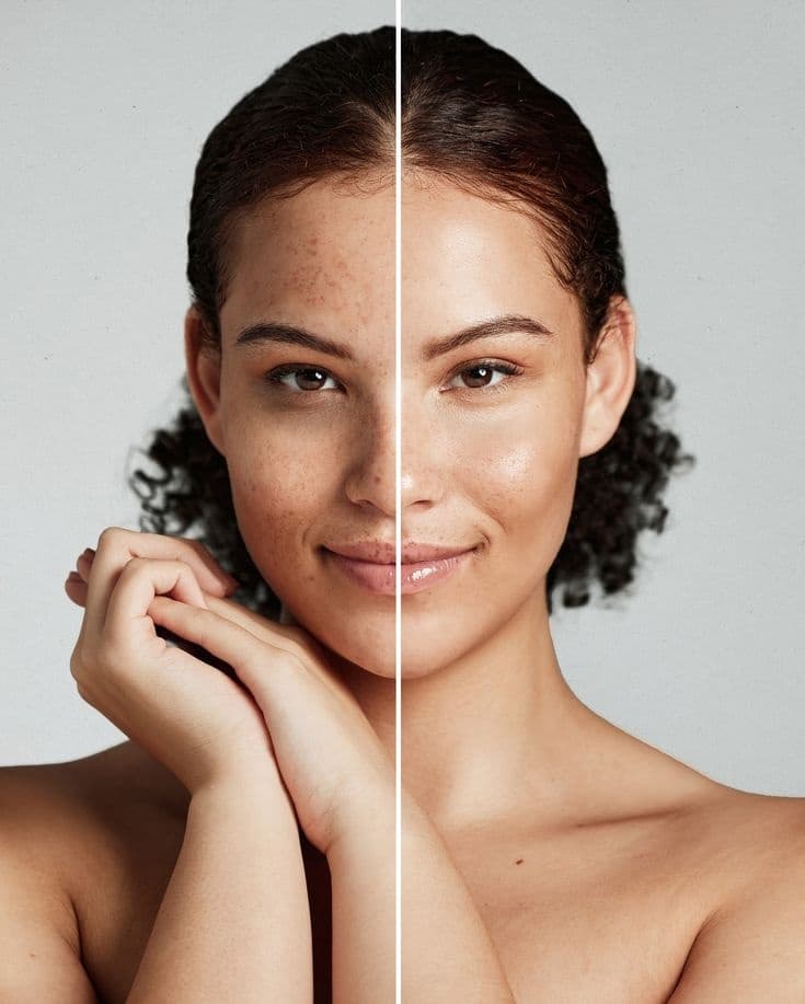 Skin Brightening & Toning Laser