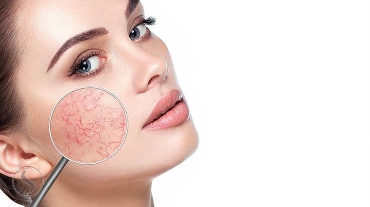 IPL Vascular Treatment